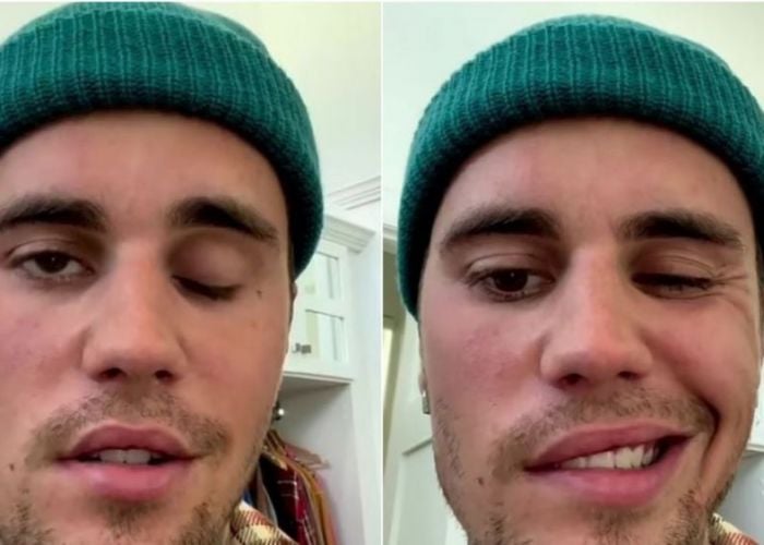 Cu fața încă paralizată, Justin Bieber își anulează din nou concertele: Sănătatea mea trebuie să fie o prioritate!